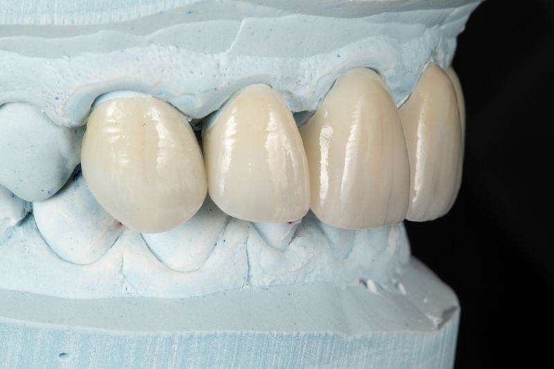 dental veneers